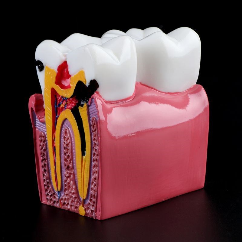 6 Times Dental Caries Comparation Anatomy Teeth Model for De