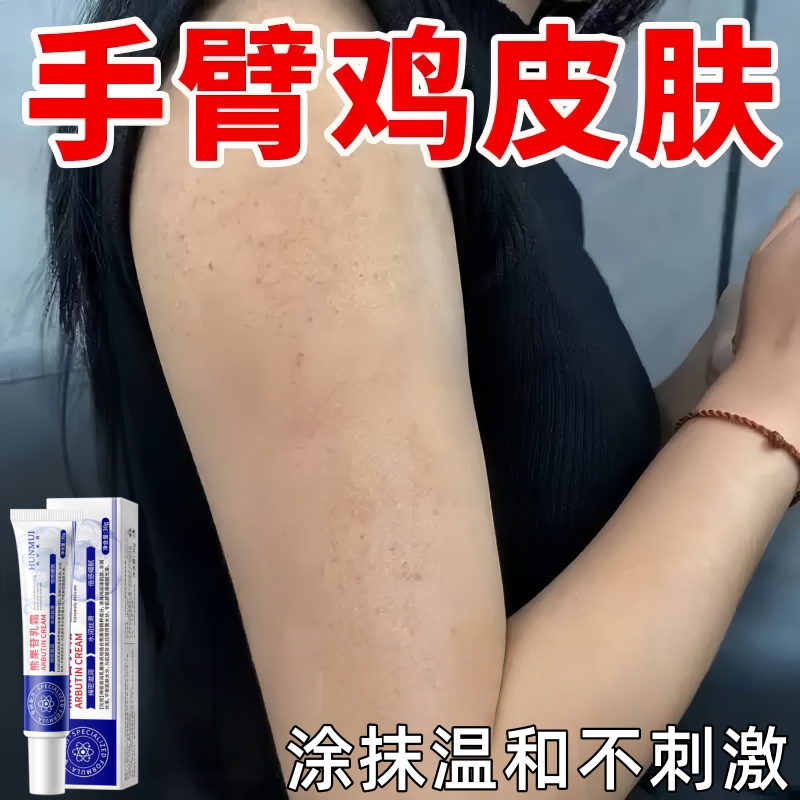 胳膊鸡皮肤疙瘩毛囊毛周角化去除症手臂脸上腿部药胳膊红点黑点膏