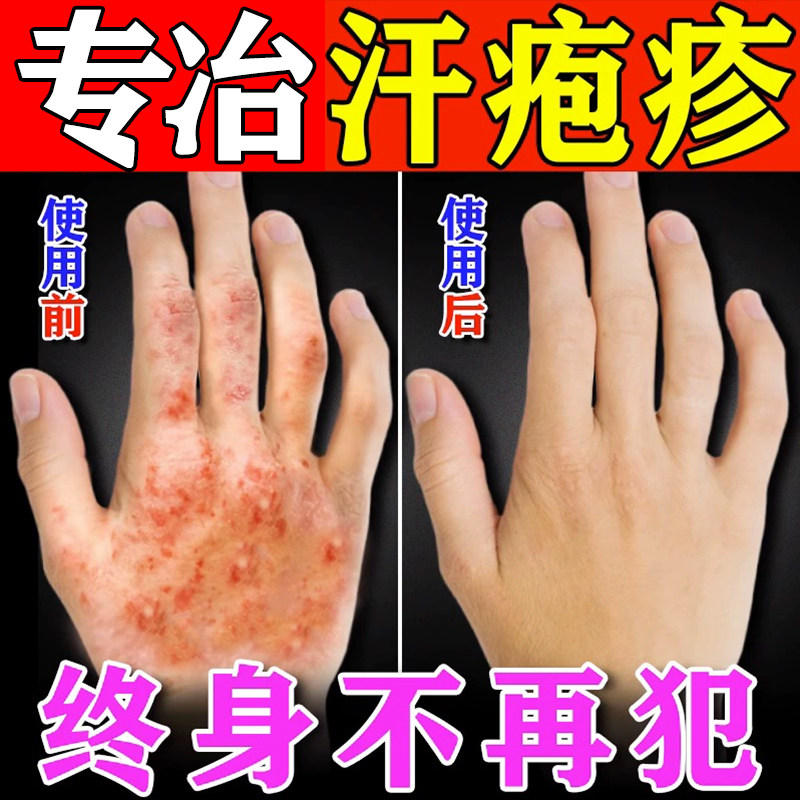 手上起小水泡专用汗泡疱疹药膏鹅掌风特效药汉状真菌感染手气膏