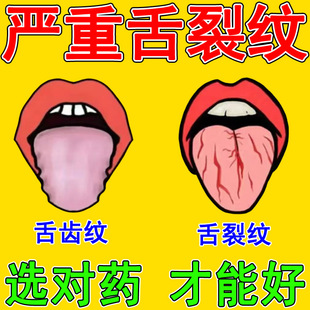 舌头有裂纹有齿痕地图舌下有青筋舌沟纹舌苔发白发厚腻湿气舌头疼