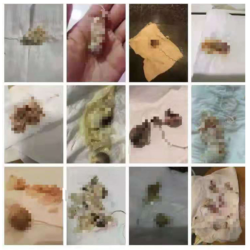 女性私处护理妇科清宫丸排毒正品妇保宁金圣丹凤宝宁阴道松弛干涩