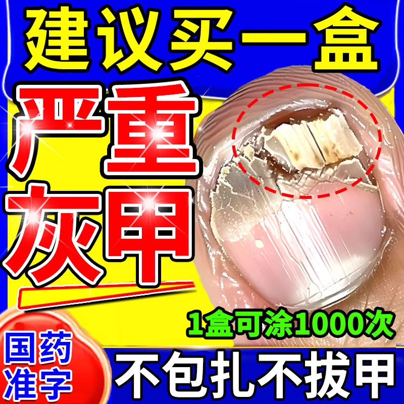 灰指甲治疗专用药正品旗舰店甲癣脚指甲真菌感染灰指甲抑菌效药膏