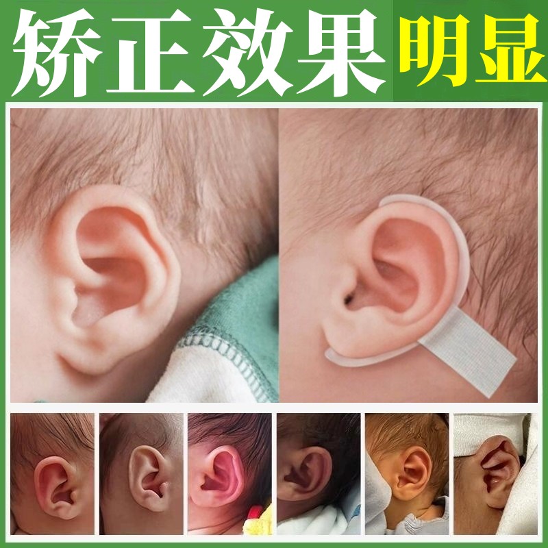 【醫院同款】嬰兒幼兒耳朵矯正器