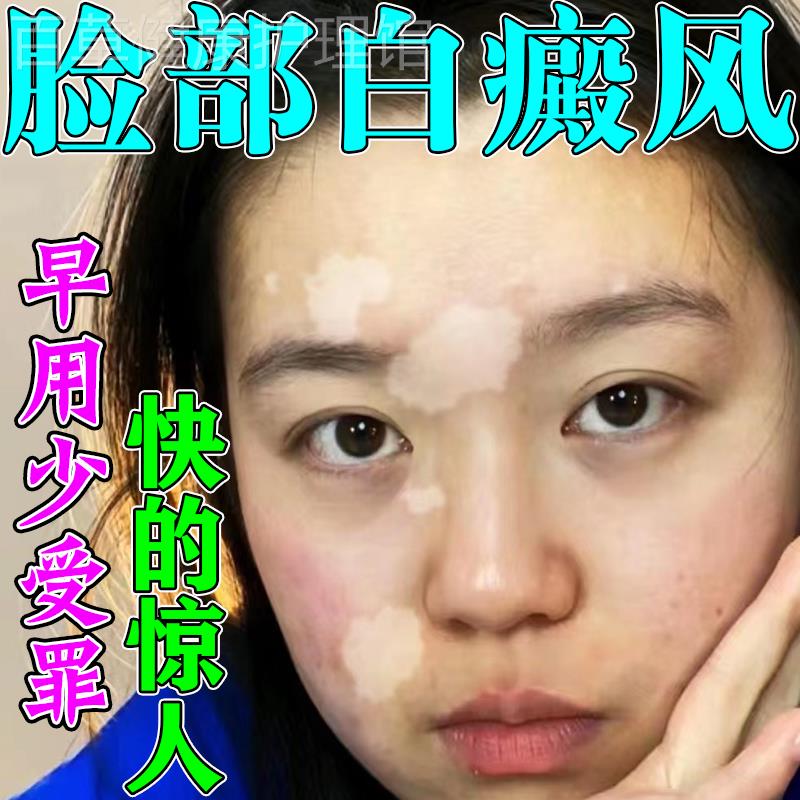 治疗脸部白癜风外用药膏快速消白斑专用外用药黑色素生长乳膏神器