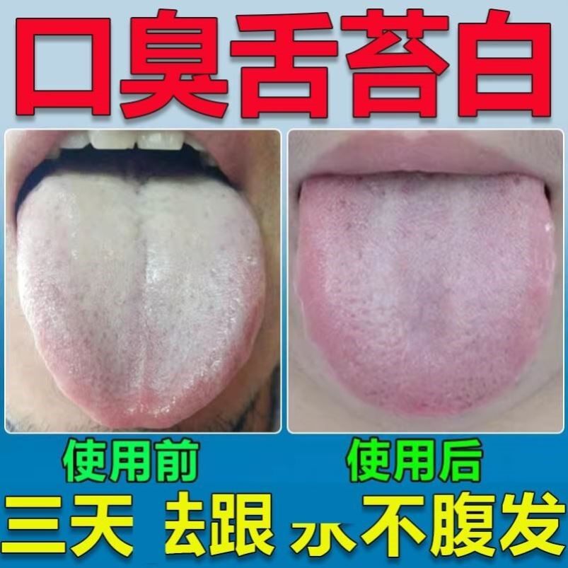 舌头发白舌苔厚裂纹有齿痕肝火旺盛上火舌头泡口干口苦甜品喷剂