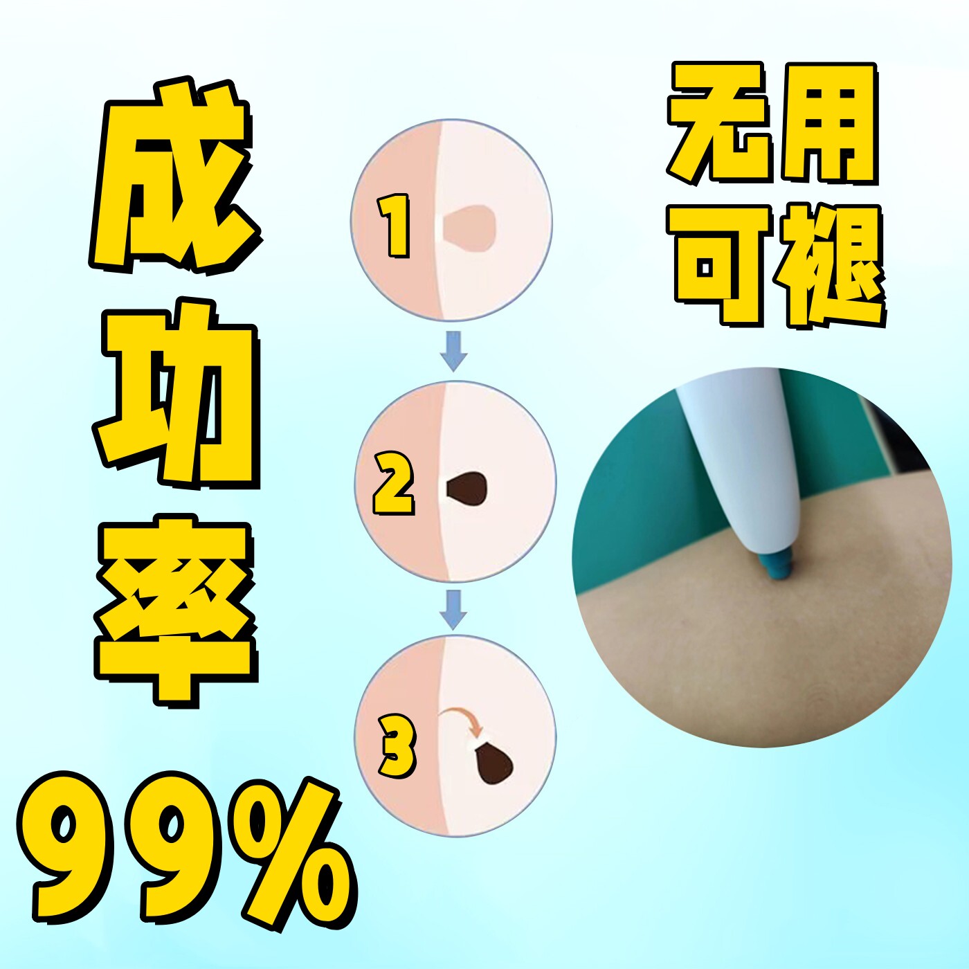 皮赘去除神器勒腋下脖子小肉粒球物理祛除工具胶圈皮筋神器