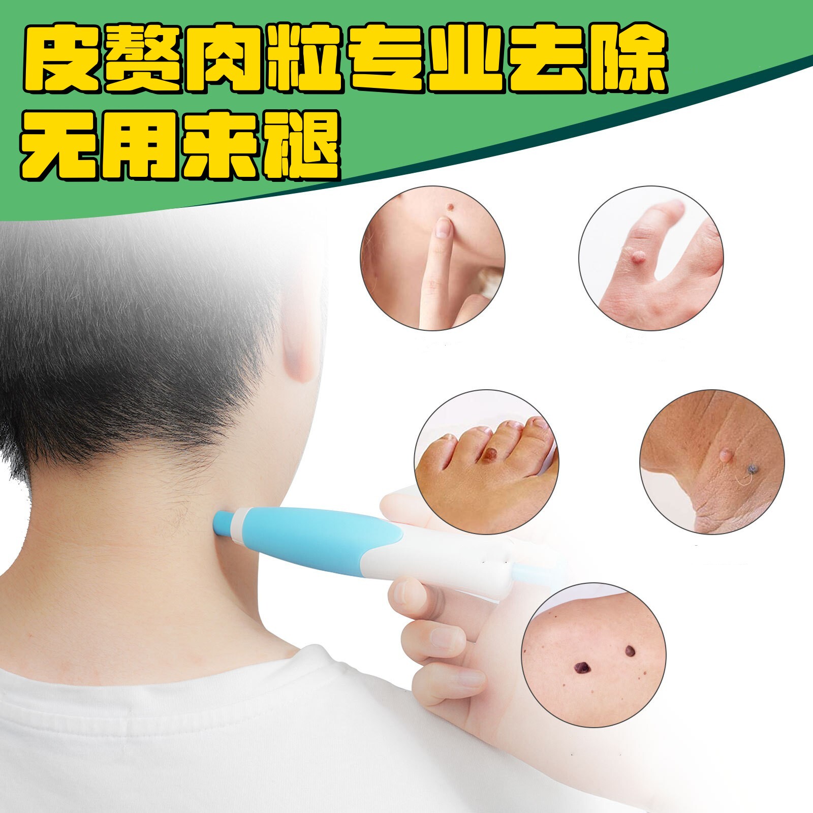 肉瘤疣瘊疙瘩肉粒球皮赘去除神器