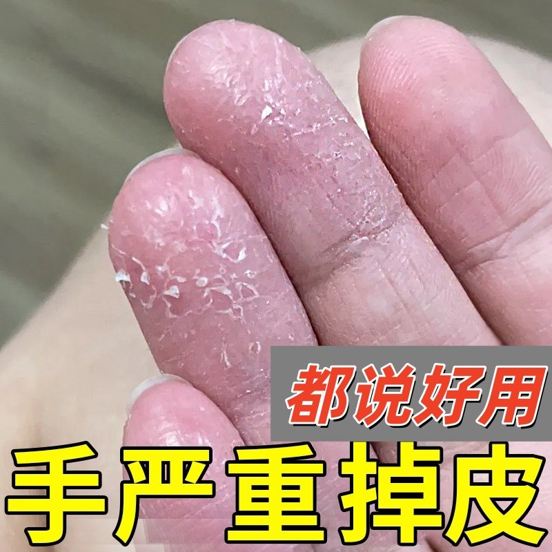手足脱皮退皮膏手上干皮干燥掉皮严重的药手指手掌脚专用真菌感染