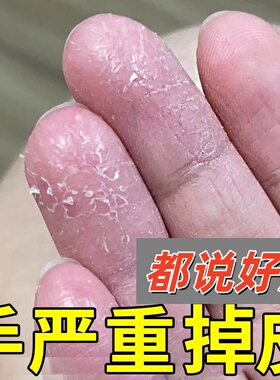 手足脱皮退皮膏手上干皮干燥掉皮严重的药手指手掌脚专用真菌感染