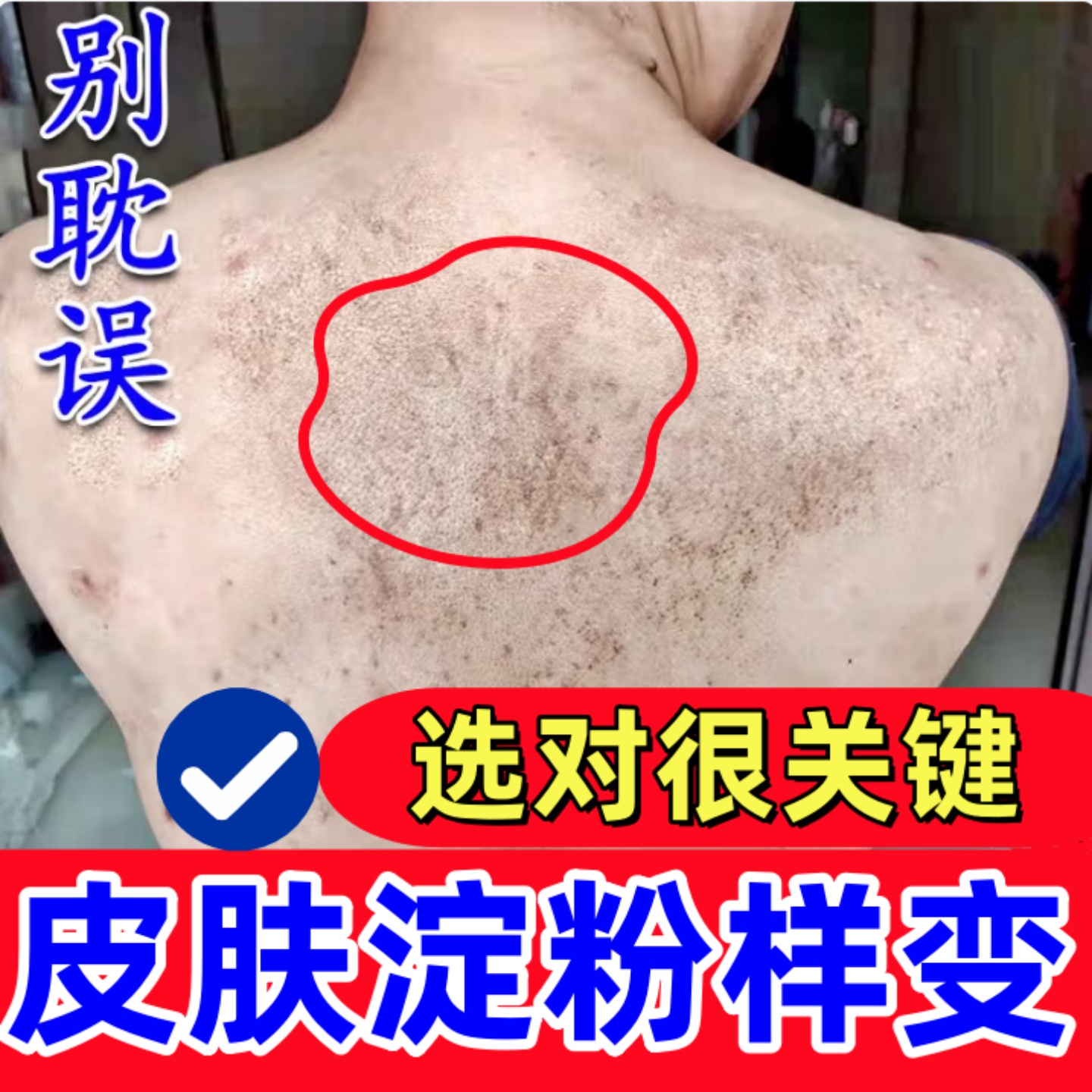 皮肤淀粉样变专用药治疗顽固后腿小腿粗糙颗粒黑色素沉淀止痒专用