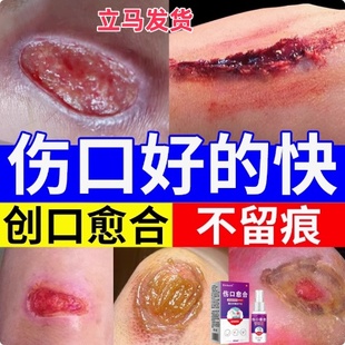 伤口愈合快速长肉金创药膏结痂不留疤的药烧伤烫伤外伤擦伤喷雾剂