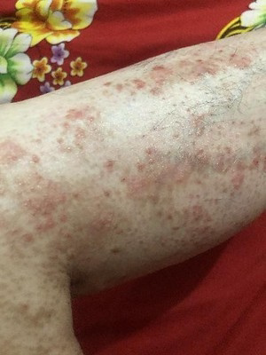 治疗玫瑰糠疹牛皮藓癣银屑病皮肤过敏红疹瘙痒龙凤膏草本专用药膏