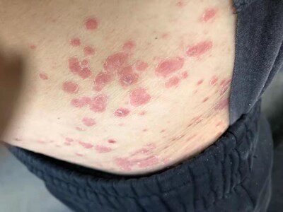 专业去牛皮癣皮炎湿疹手足癣皮肤瘙痒红斑掉屑抑菌止痒慢性牛癣药