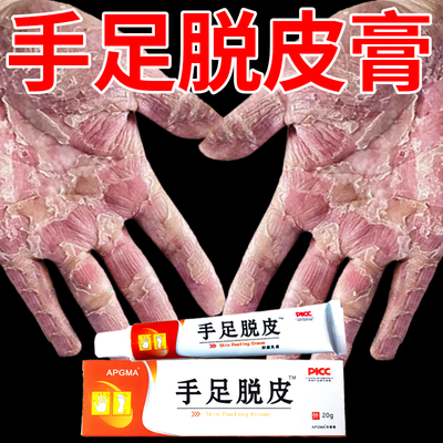 手足脱皮膏手指上起皮干燥爆皮儿童手掌蜕皮手心手脚掉皮褪头专用
