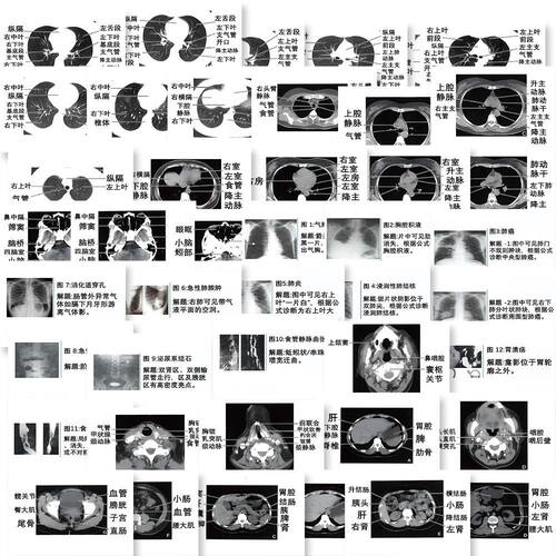医学影像分析贴纸医学生CT图解