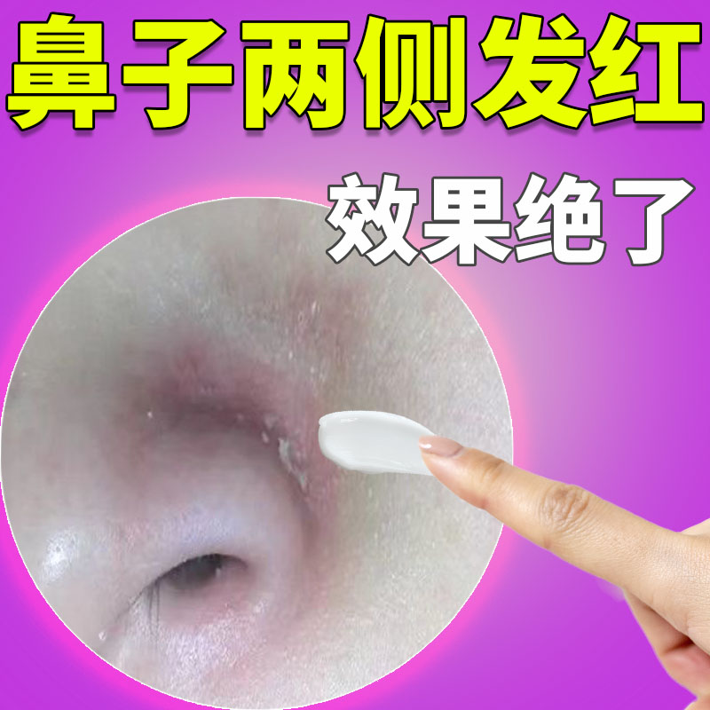 鼻子两侧发红脱皮鼻翼起皮
