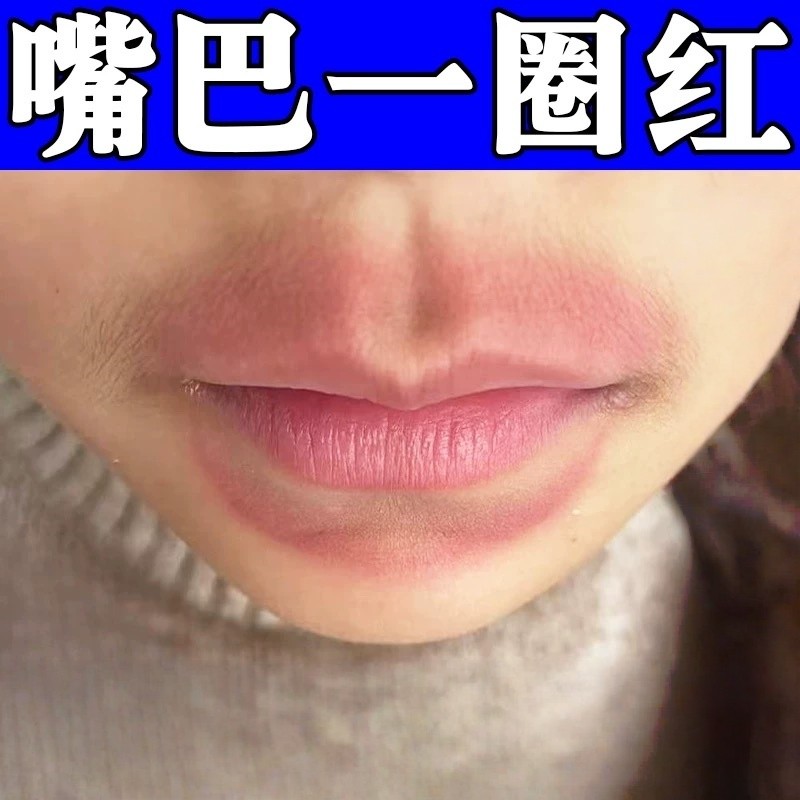 儿童嘴巴一圈红专用药去羊胡子疮小孩舔嘴唇干燥起皮红肿干裂唇膏