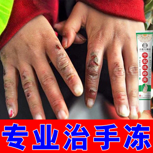 冻疮膏修护冻伤膏药冬天手脚冻伤冻裂手指脚趾耳朵脸冻伤皴裂乳膏