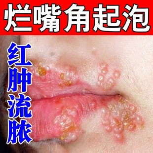 嘴唇疱疹药膏干裂起皮红肿上火蜕皮感染单纯疱疹痒唇炎专用抑菌膏