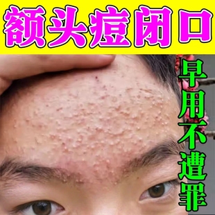 去额头痘痘脸上起小疙瘩长痘痘闭口粉刺的克星去除脸部额头下巴痘