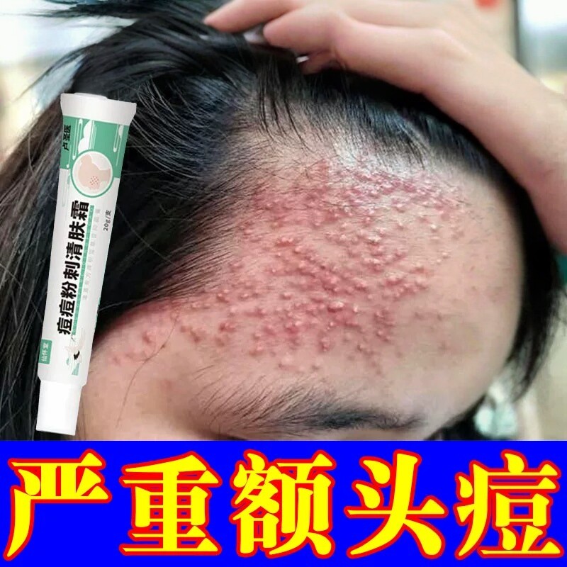 青少年额头上长痘痘闭口粉刺小疙瘩学生额头上有颗粒头部痘痘乳膏