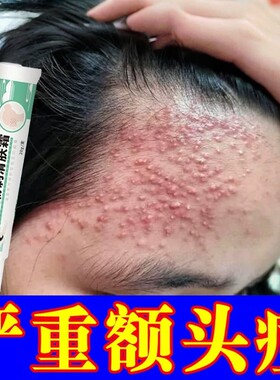 青少年额头上长痘痘闭口粉刺小疙瘩学生额头上有颗粒头部痘痘乳膏