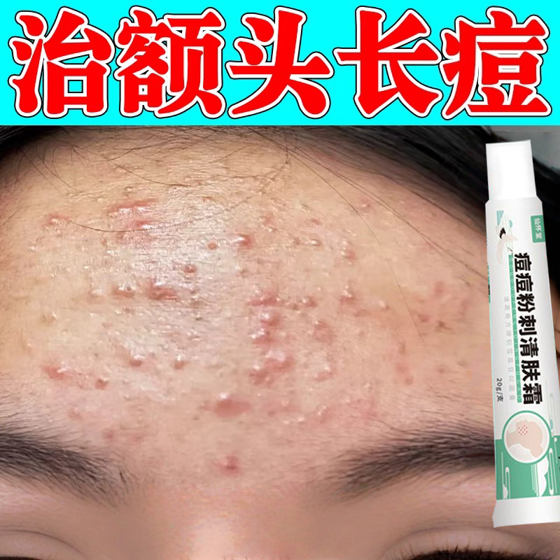 治额头痘痘闭口小疙瘩脂肪粒脸部熬夜上火长痘粉刺逆光疹专用乳膏