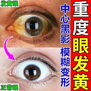眼白发黄有黑点眼球黄斑眼底出红血丝玻璃体混浊干涩发痒去黄疼痛