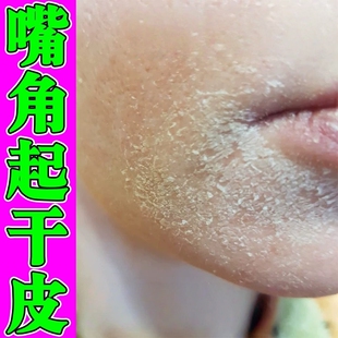 脸上皮肤干燥起皮额头泛红痒脱皮过敏药膏男女嘴角有碎屑修复霜