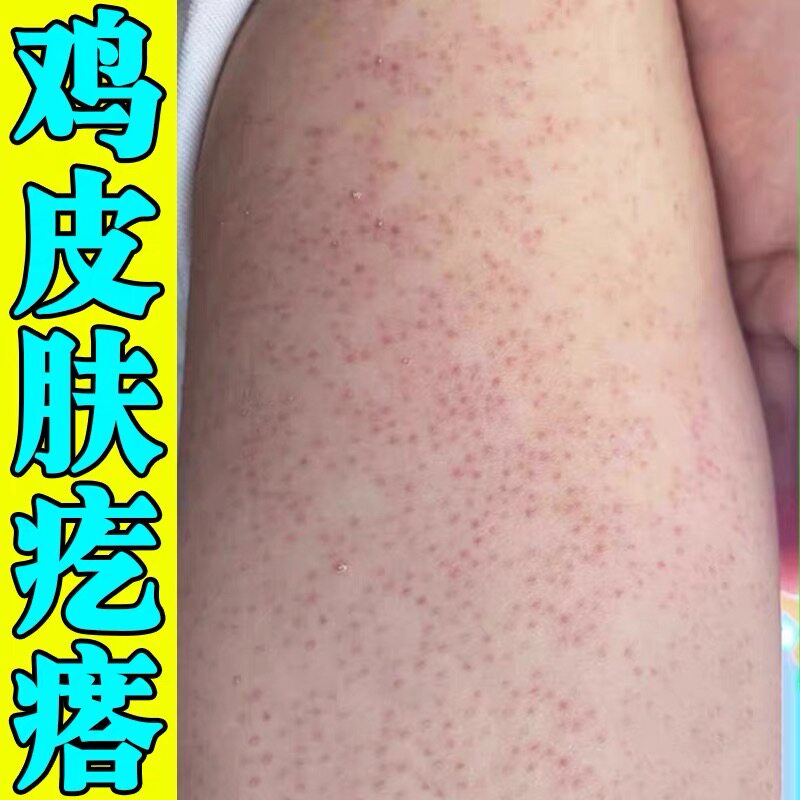 手臂鸡皮肤疙瘩毛囊毛周角化症去除胳膊全身腿上小颗粒黑红点膏