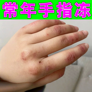 儿童手指脚趾长冻疮红肿痒冬天冷耳朵手足脸部防冻伤防冻裂修复膏