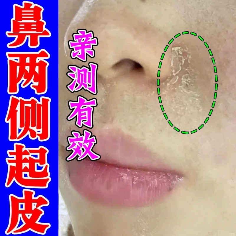 鼻子两侧发红脱皮鼻翼两边泛红脱皮脸上脂溢性皮炎过敏干燥抑菌膏