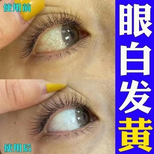 眼白清澈去黄修复发黄眼睛红血丝眼底眼药水叶黄素滴眼液