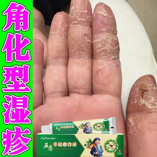 角化型湿疹手指脱皮干裂手足癣真菌感染角质增厚发硬皲裂止痒药膏