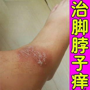 脚脖子痒冬天脚脖痒脚踝痒脚背发痒真菌感染治小腿痒皮肤干燥脱皮