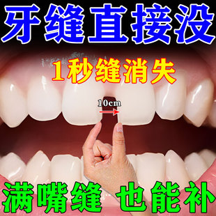 牙齿缝隙填充剂矫正器门牙牙缝大塞牙补牙齿洞膏固齿牙齿松动克星