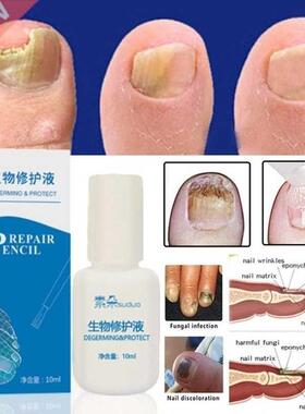 10ml /1Pc Chinese Medicine Herbs Toe Nail Fungus Treatment M