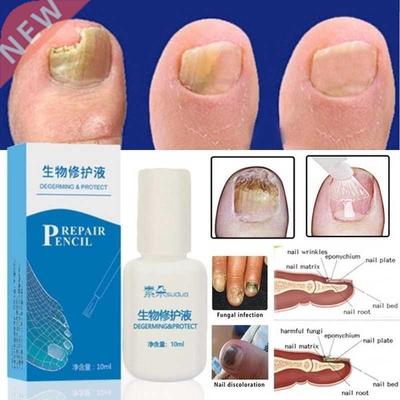 10ml /1Pc Chinese Medicine Herbs Toe Nail Fungus Treatment M