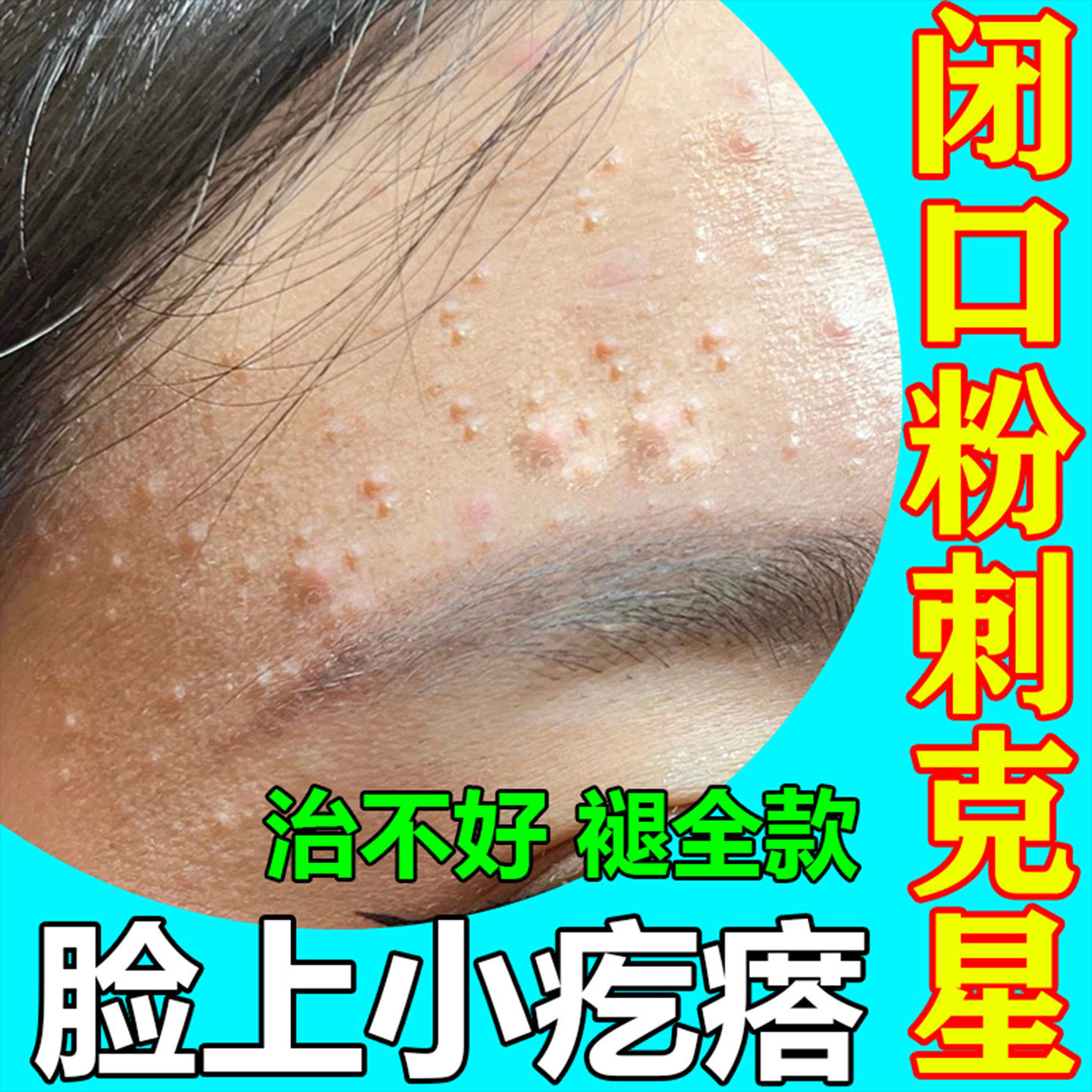 闭口粉刺脸上起小疙瘩去除承认儿童脸部逆光疹闭合痤疮祛额头痘