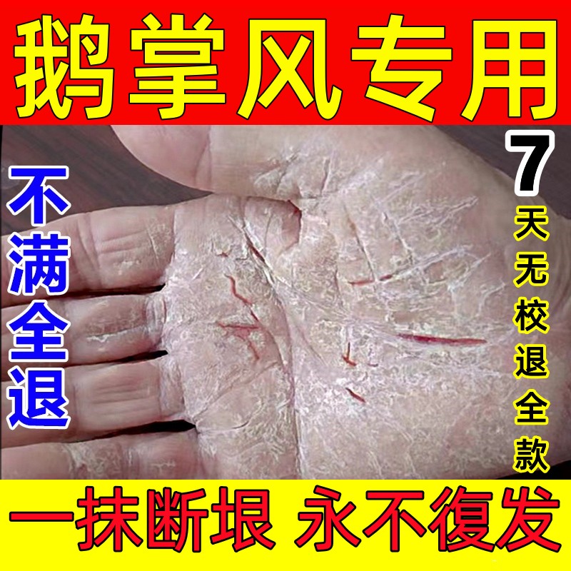 鹅掌风特效药干裂脱皮止痒抑菌手脚癣汗疱疹真菌感染专用手气药膏