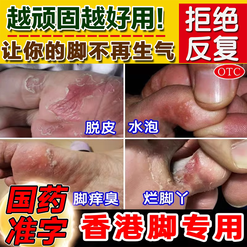 碘伏治脚气止痒脱皮杀菌烂脚丫去特效专用药根非唯达宁喷雾剂3BF