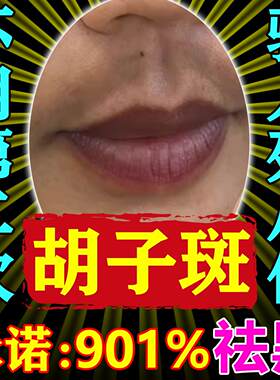 去胡子斑神器改善嘴角黑色素沉淀去除嘴唇发黑发紫淡化暗青祛斑膏