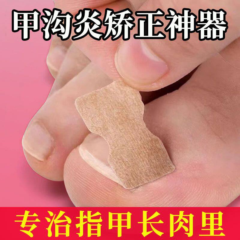 正甲贴甲沟炎嵌甲矫正免胶水矫正正甲贴片脚趾变形指甲新款长肉里
