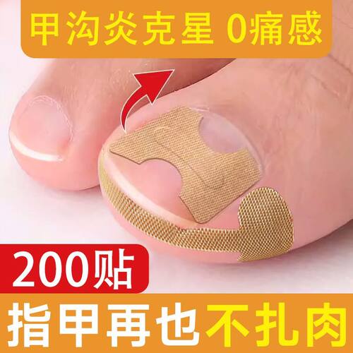一贴渐校免胶水正甲贴片指甲嵌肉矫正神器专用修正脚趾甲长肉里