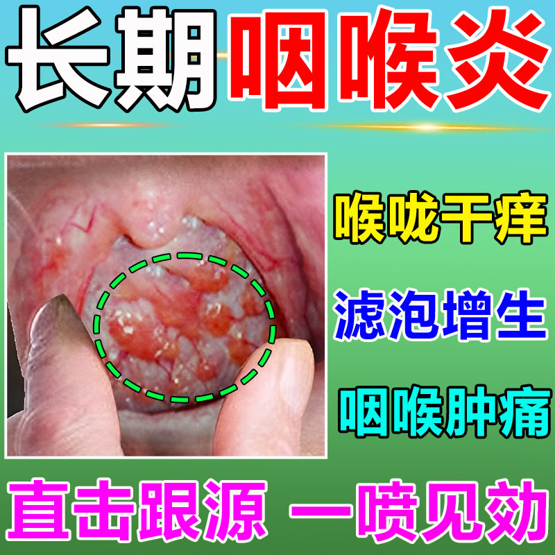 治疗烟炎慢性咽炎除根咽喉炎异物感神器滤泡增生喉咙肿痛发炎专用 宠物/宠物食品及用品 皮肤喷剂 原图主图