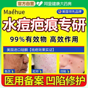 凹陷性水痘疤痕修复去水痘坑填充膏凹洞可搭生长因子儿童凹坑祛疤