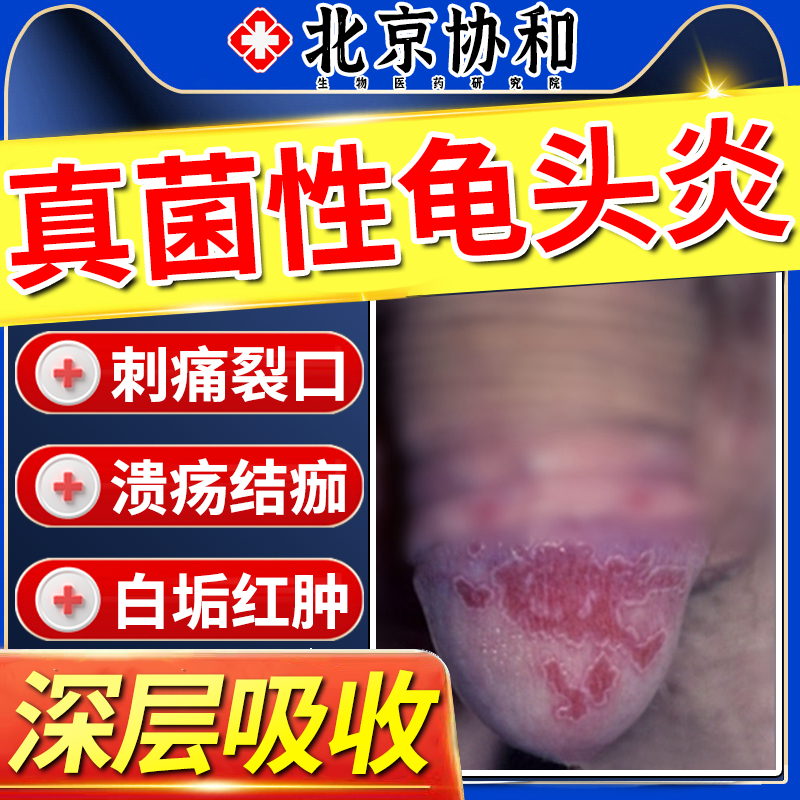 【男科医用】包皮开裂红肿发炎