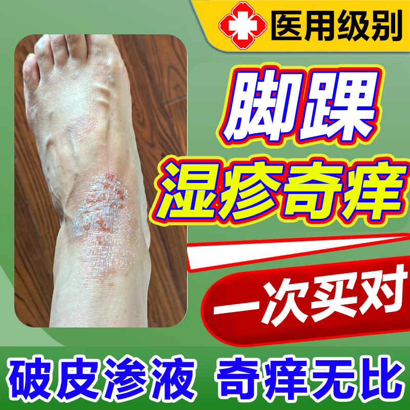 脚踝湿疹脚足癣瘙痒不含激素一次
