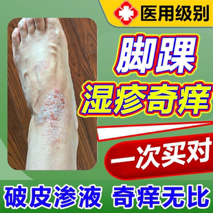 脚踝湿疹奇痒脚背止瘙痒脚足癣藓一次顽固皮炎真菌感染苗无激素wg