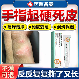 手指硬皮癣角化型增厚瘙痒死皮变硬真菌专神经性皮炎藓用药监备wg